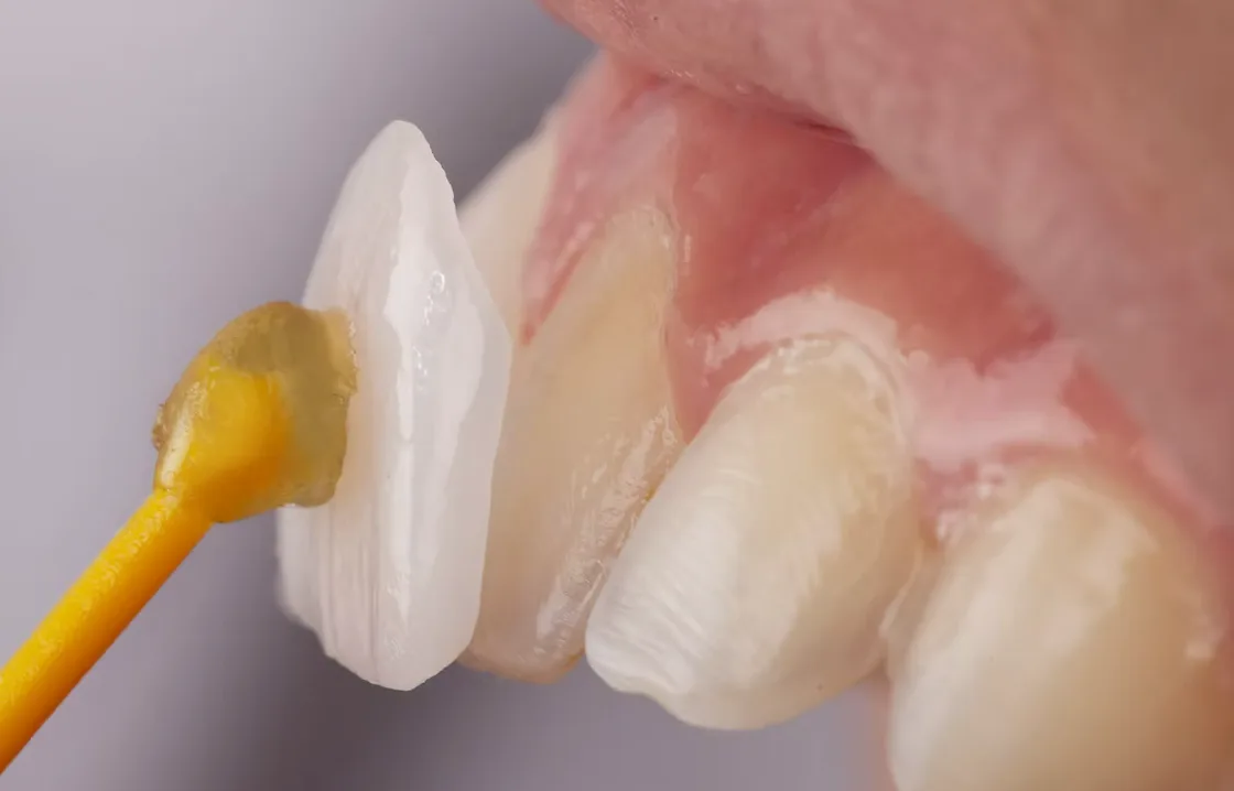 A minimal-prep ceramic veneer being seated on a prepared front tooth