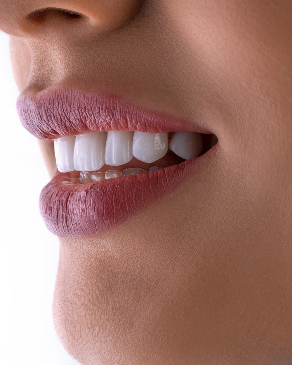 Porcelain veneers viewed close up