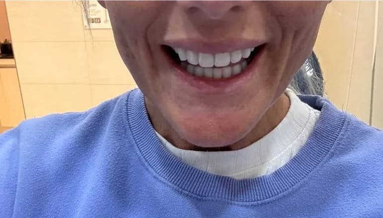 Siobhan's smile after a two-day full-mouth makeover in Seoul