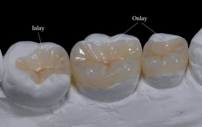 Dental filling, inlay, onlay, and crown materials for a Korea restorative dentistry guide